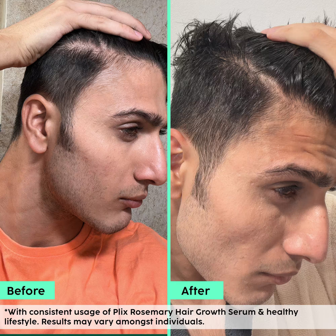 Rosemary Advanced Hair Growth Serum for Pattern Baldness | Promotes New Hair Growth